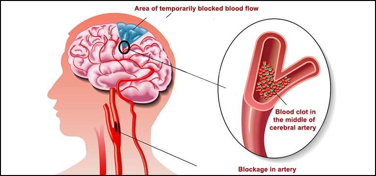 Does Transient Ischemic Attack require MRI Brain Angiography?